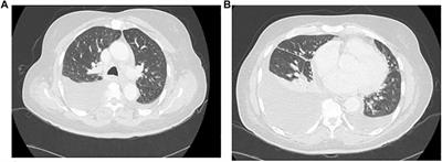Anasarca, and Lymphadenopathy in a Kidney Transplant Patient: A Diagnostic and Therapeutic Challenge